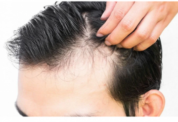 Шаш түсуінің негізгі бір себебі айтылды