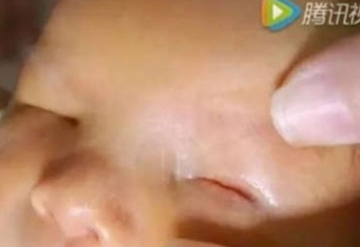 В Китае родился ребенок без глаз