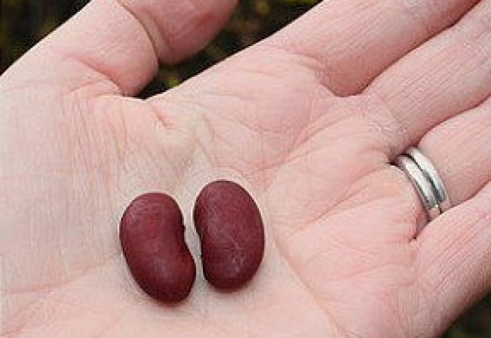 Елімізде 3 мыңға жуық адам бүйрек ауыстыруға мұқтаж