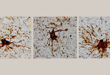 Адам өлгеннен кейін белсенді әрекетке көшетін зомби жасушалар табылды