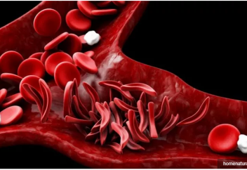 Орақ тәрізді жасушалы анемияны бір минутта анықтаудың тәсілі табылды