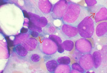 Аса қауіпті лейкемияның пайда болу себебі анықталды