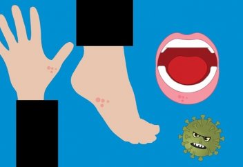 Французские врачи указали на кожный симптом COVID-19. Ожирение — тот фактор, который увеличивает риск для здоровья с диагнозом COVID-19