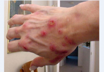 Тері арқылы көрініс табатын 8 ауру