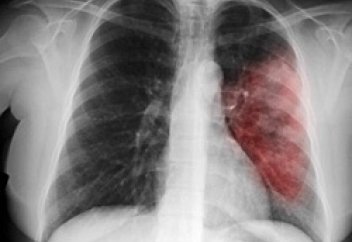 Пневмонияны анықтаудың оңай жолдары