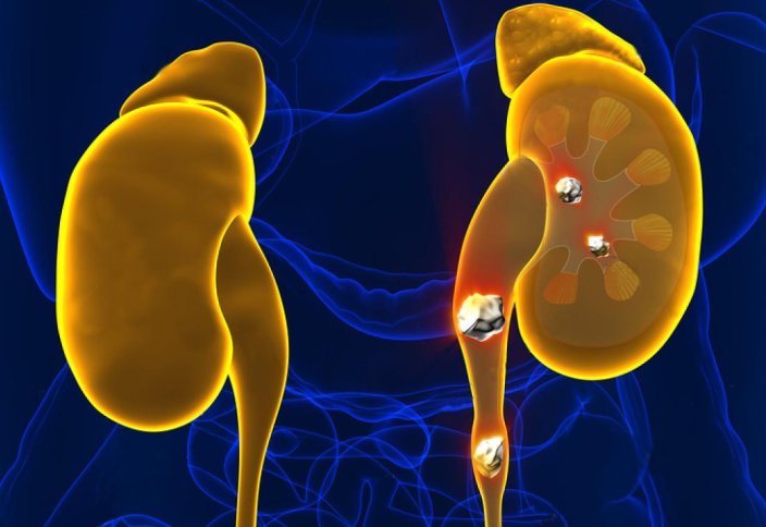 Титтей магнитті робот бүйректегі тасты ерітеді (видео)