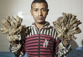 «Ағаш» адамға ота жасалды (видео)