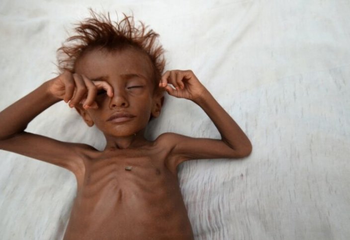 Разные: ООН сообщила о гибели 10 тыс. детей в Йемене из-за войны