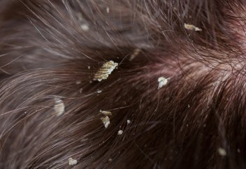 Қайызғақ қауіпті аурудың бір симптомы (белгісі) болып шықты