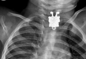 16 айлық сәбидің өңешінен "Спанч Боб" табылды