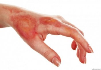 Күйік шалғанда дереу не істеу керек?