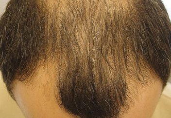 Стреске байланысты шаштың түсуіне ықпал ететін тетік табылды