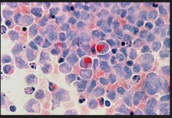 Қатерлі ісік ішінен қауіпті бактерия табылды. Тері обырын қан анализі арқылы анықтау тәсілі пайда болды