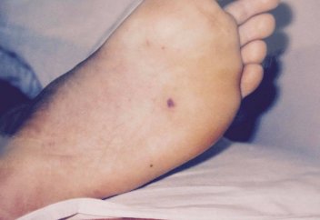 Қанша адам менингококк инфекциясынан қайтыс болды?