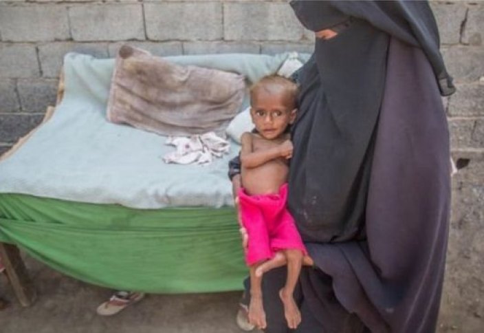 ООН: С начала года в Йемене от кори умерли 77 детей