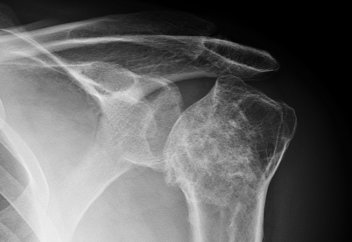 Рентген сәулесінің сүйекке орасан зор әсері бары анықталды