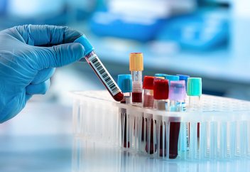 Британ ғалымдары қан талдауы арқылы қатерлі ісікті анықтаудың жаңа әдісін ойлап тапты