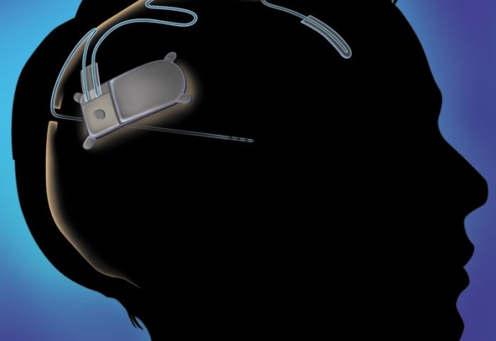 2033 жылға қарай ми импланттары нарығы $8,2 млрд жетеді