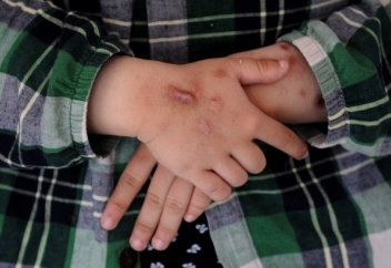 Шрамы больше не в моде: найден способ заживления кожи без рубцов