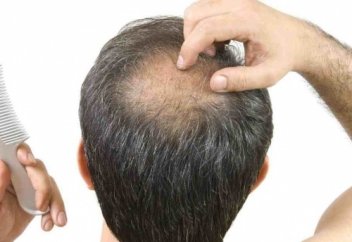 Ер адамдар неліктен таз болады: Себебі айтылды