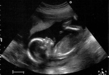 В США отменили право на аборт: теперь женщины выбирают стерилизацию