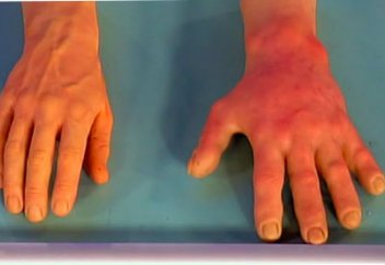 Аллергиямен күресу әдістері