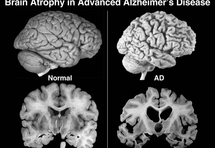 Альцгеймер ауруына қатысты 3 жаңалық