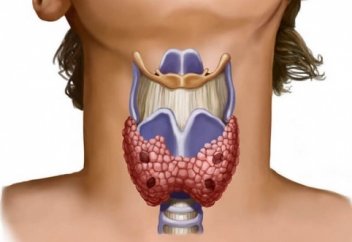 Зоб ауруынан қалай емделуге болады?