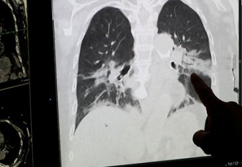 Найден способ спасать легкие пациентов с коронавирусом. Бессимптомный ковид гораздо опаснее. Солнечный свет уничтожает коронавирус за 15 минут