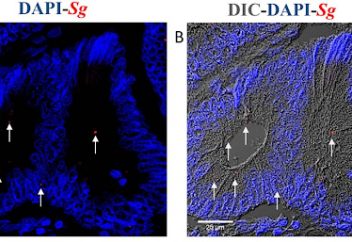 Қатерлі ісіктен микробтың ізі табылды