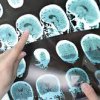 Болашақта пайда болатын емі жоқ аурудың белгісі аталды