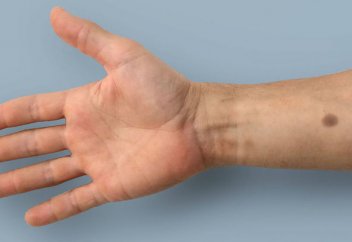 Новая "татуировка" в виде родинки проявится на коже, если обнаружит опасное заболевание (фото)