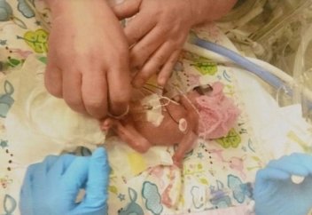 600 грамм салмақпен дүние есігін ашқан шақалақтың таңғажайып оқиғасы (ВИДЕО)